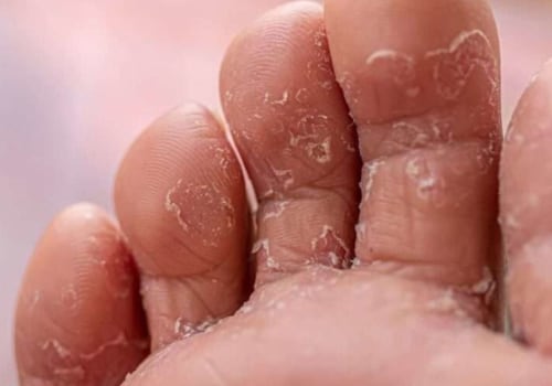 Worried About Toe Fungus? What Is Athlete's Foot Fungus Between the Toes and How to Prevent It